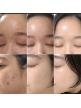 ナナラ(nanala)/ルビーセルの肌変化！