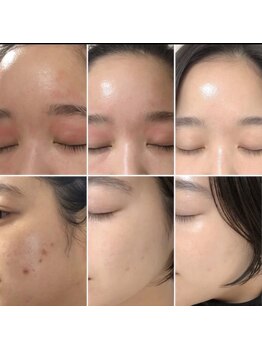 ナナラ(nanala)/ルビーセルの肌変化!