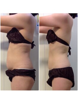 OBS/お腹集中痩身モニター