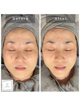 サロン ド パーフェクション(Salon de Perfection)/小顔リフト