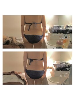 アクア エステティコ 亀有(ACQUA estetico)/中半身痩身　半年経過