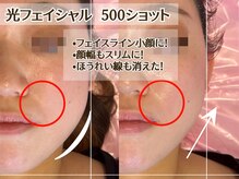 ヴィオール 名古屋栄店(VIOR)/小顔　光ショット施術　