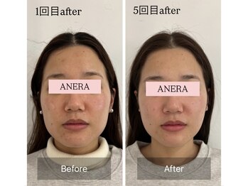 アネラ 難波(ANERA)/20代女性 ニキビ/フェイスライン