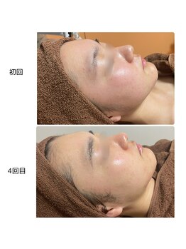 トータルビューティーサロン ヴィヴィエ(ViVier)/ララピール症例 4回