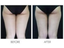 太もも＆バナナロール(お尻と太ももの堺)足長ヒップアップ効果