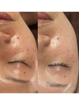 アロマジャムゥ 庚午店/ララピールbefore→after