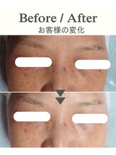 ココプレジール(Cocoplaisir)/シミ/くすみ