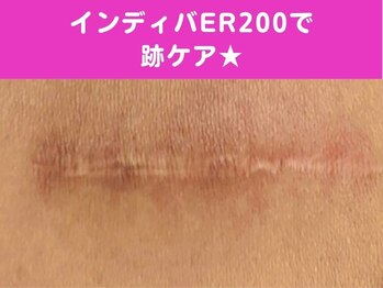 オリエンタルローザ 表参道(Oriental Rosa)/インディバER200でお悩み解決！