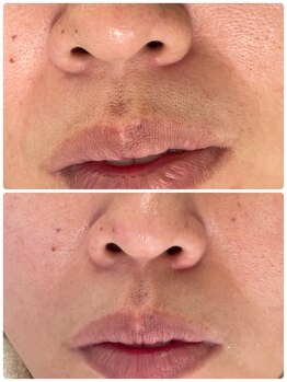 エン(enn)/【法令線・ハリ】