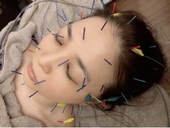 モクレンの写真/【美容鍼×電気パルス】ターンオーバーを促進しシワ、たるみ改善♪プロの施術で満足度◎