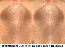 ベリンダ(BELINDA)/毛穴洗浄ハイドロスプラッシュ