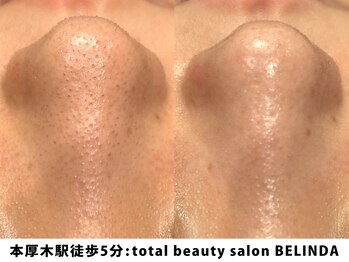 ベリンダ(BELINDA)/毛穴洗浄ハイドロスプラッシュ