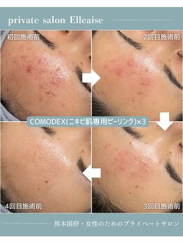 エルエーズ(Elleaise)/しつこい大人の肌荒れも改善!