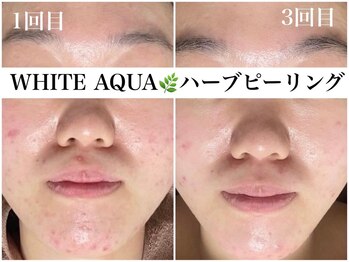 ホワイトアクア 広島店(WHITE AQUA)/ハーブピーリング/ニキビケア