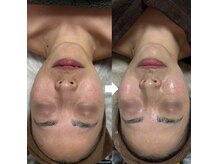 本気の肌質改善！お肌についてご相談お待ちしております！