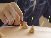 御徒町よつば整骨院/お灸