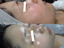 ナチュールムーン(Nature moon.)/ハーブピーリング