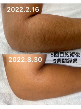 アシヤ髭ラボ(ASHIYA 髭 LABO)/うで脱毛ビフォーアフター