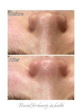 ルシアル(Rucial)/白玉ワックス◇Before／After