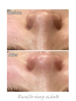 ルシアル(Rucial)/白玉ワックス◇Before／After