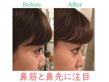 ラプリ 福岡博多店(Raplit)/隆鼻+輪郭・小顔矯正 美鼻/小顔