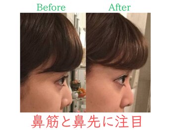 ラプリ 福岡博多店(Raplit)/隆鼻+輪郭・小顔矯正 美鼻/小顔