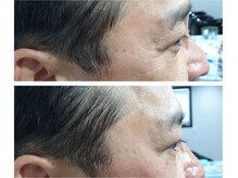 アネモネ ビューティーズ サロン(Anemone Beauty's salon)/ララピールBefore→After