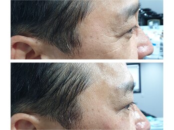 アネモネ ビューティーズ サロン(Anemone Beauty's salon)/ララピールBefore→After