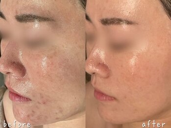 エヌエースキン 北谷店(NAskin)/ハーブピーリング｜ニキビケア