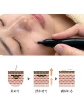 ブライズ(BRISE)/シミケア