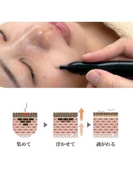 ブライズ(BRISE)/シミケア