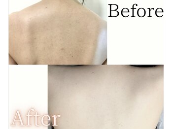 イーサム(e-sam)/背中脱毛