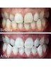 セルフホワイトニング☆回数券をお持ちのお客様はこちらから☆