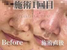 マシェリ(macherie)/毛穴のお掃除しませんか？