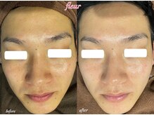 フルール(Fleur)/◆メンズ美容/若見え肌/ハリ艶◆