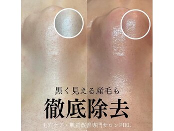 ピエル 北千住店(PIEL)/黒く見える産毛も徹底除去