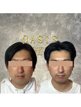 オアシス トウキョウ 川崎店(OASIS TOKYO)/OASIS式脂肪術８回