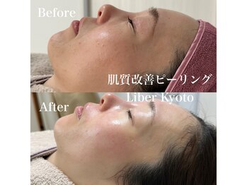 リベルキョウト 京都駅前店(Liber Kyoto)/肌質改善ピーリング