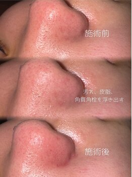 アクシア ビューティー サロン(AXSIA)/【毛穴洗浄】