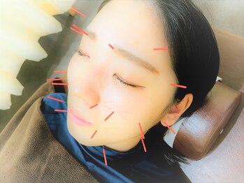 東灘区甲南山手わだち整骨院の写真/ニキビケア・シワたるみ改善や小顔など、お顔の血行促進でいつもの化粧水が入りやすいお肌に◎【美容鍼】