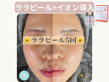 イーラボ 池袋店(e-LABO)の写真/【韓国式肌管理《ララピール&プラピール》で徹底美肌】本気の陶器肌!毛穴・ニキビケア・美白のトリプルケア