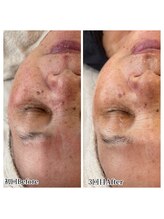 ミラビューティー(Mira Beauty)/60代ツヤ肌症例