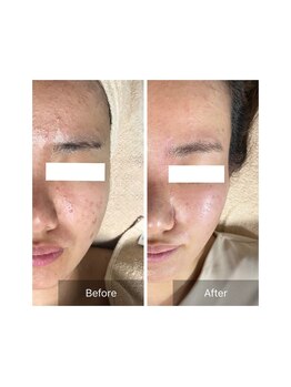 エミニティ トータルビューティーサロン(Eminity)/肌質改善酵素フェイシャル