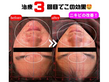 栄光治院 豊田院/美容鍼　【ビフォー/アフター】