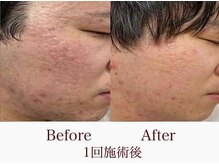 ニイヌマラボ(NIINUMA LABO)の雰囲気（最強の美肌微細針エステになります☆）