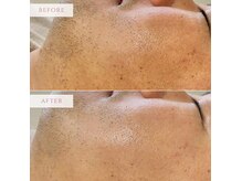 男性のお客様からもハーブピーリングのご相談増えてます♪