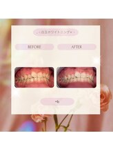 プラスビー 2号店(+b)/ホワイトニングビフォーアフター