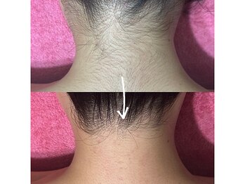 エルム 京都駅前店(elm)/＊うなじ脱毛＊