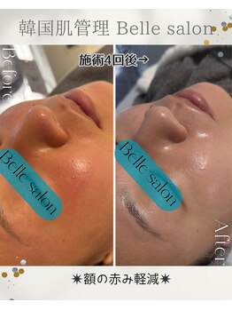 ベルサロン(Belle salon)/敏感肌ケア