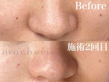 マシェリ(macherie)/毛穴の黒ずみ撃退プログラム